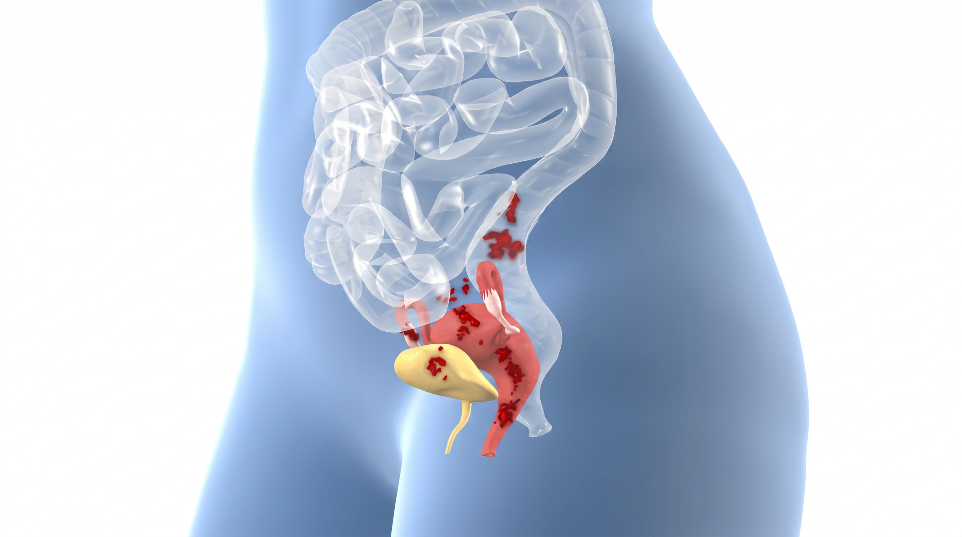 Endometrióza pod drobnohledem: Proč diagnóza trvá roky a jaké jsou možnosti úlevy?